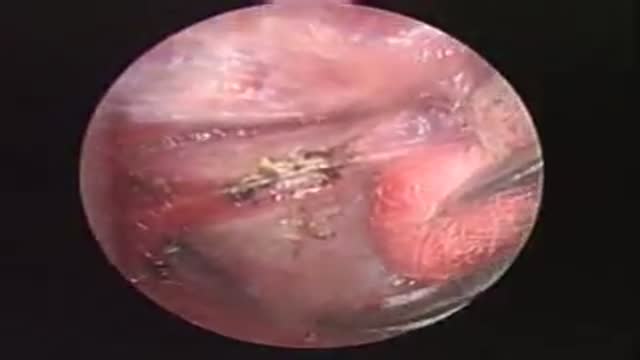 Thyroidectomy Surgery Video