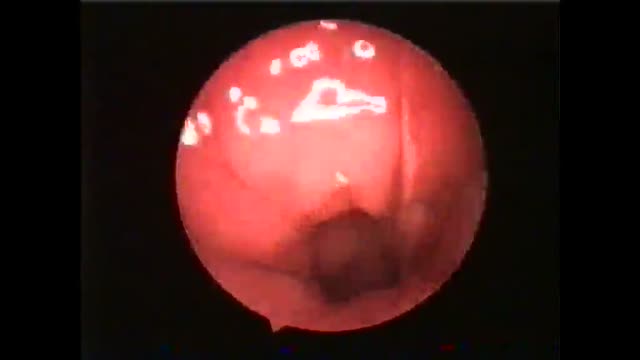 ⁣Endoscopic view of Adenoids
