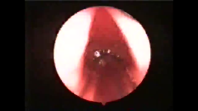 ⁣Endoscopic View of Vocal cords