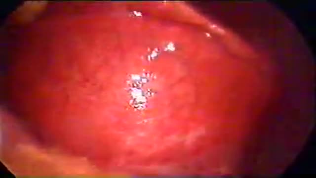 Hydatid Cyst Excision from Liver