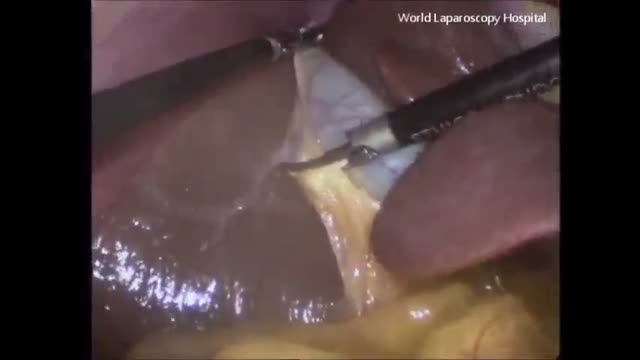 ⁣Laparoscopic Cholecystectomy HD Medical Video