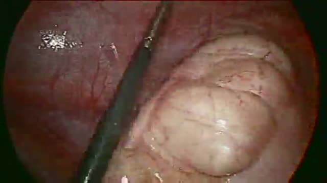 Laparoscopic Appendectomy HD