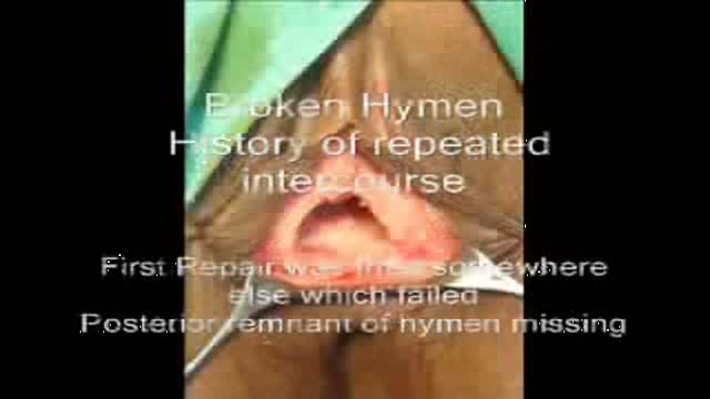 Hymenoplasty Hymen Repair Surgery