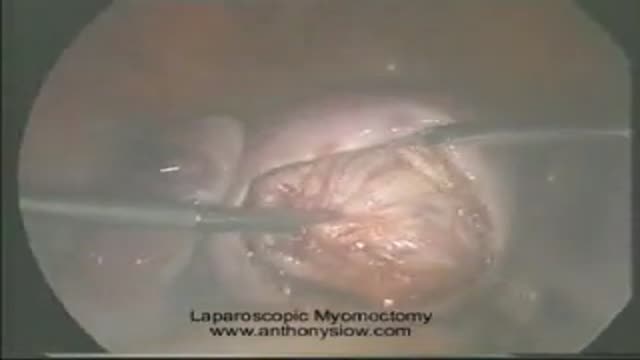 Laparoscopic Myomectomy