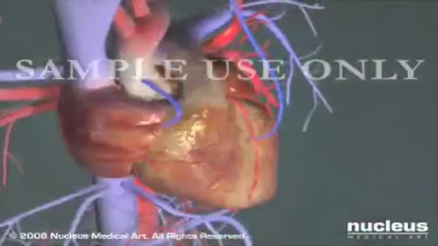 ⁣Coronary Artery Bypass Surgery CABG Heart
