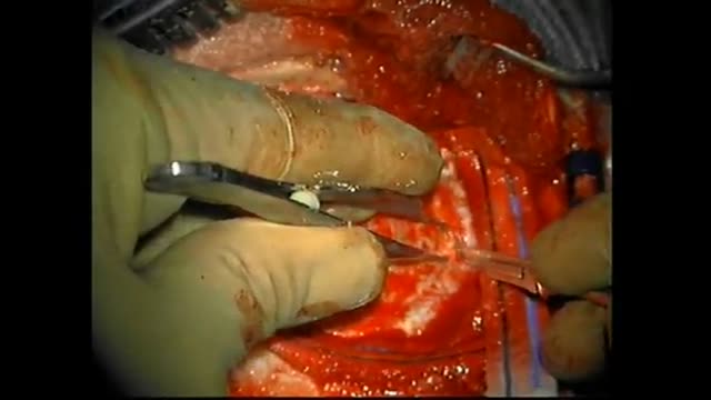 Arachnoid Cyst Brain Surgery HD