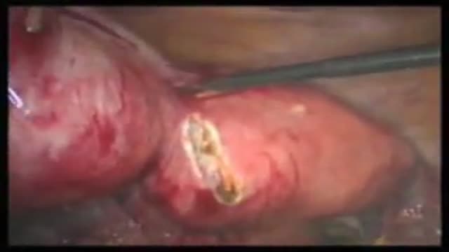 myomectomy