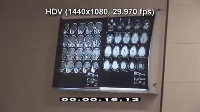 HD Brain Surgery