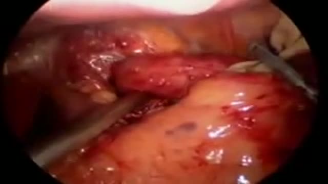 ⁣Nissen Laparoscopic Fundoplication Acid Reflux Surgery Stomach