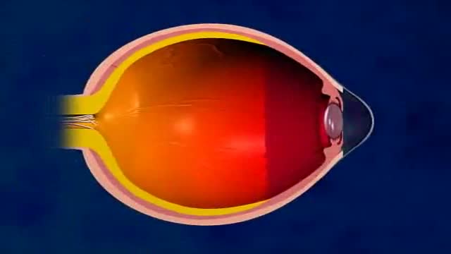 LASIK Eye Surgery 3D Animation