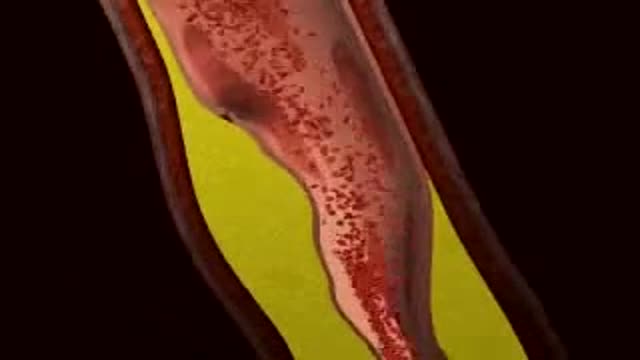 Myocardial Infarction 3D Animation