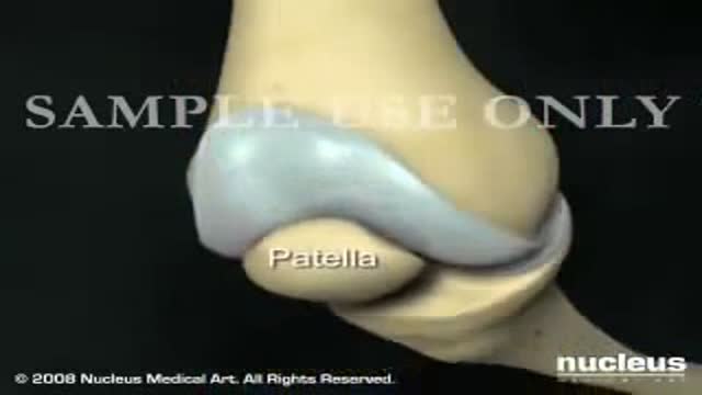 Total Knee Replacement Surgery Video