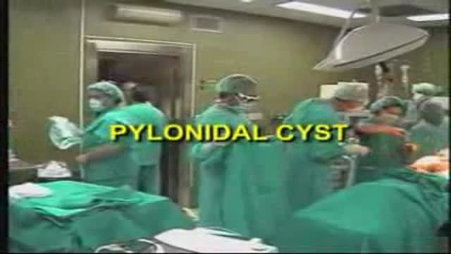 Pilonidal Cyst Removal with Laser