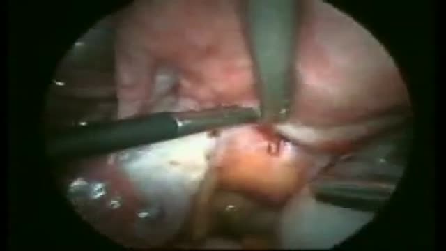 ⁣Excision of Rectovaginal Nodule