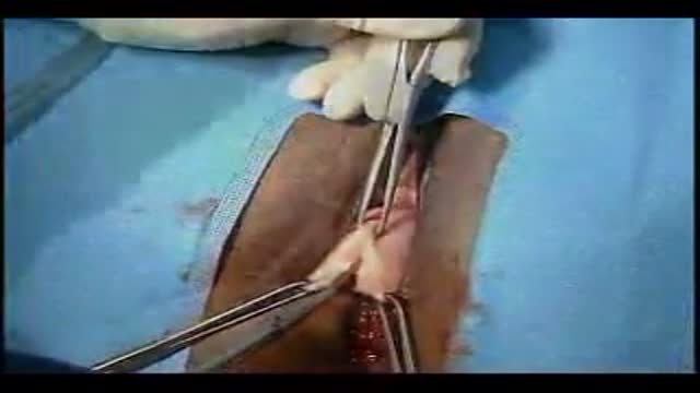 Anterior and Posterior Vaginal Repair Plus IVS Tunner