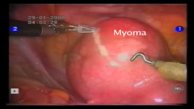 Robot - Assisted Laparoscopic Myomectomy