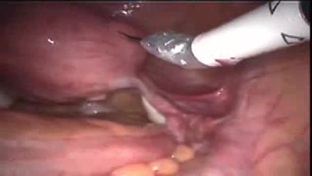 Da Vinci  Robotic Hysterectomy