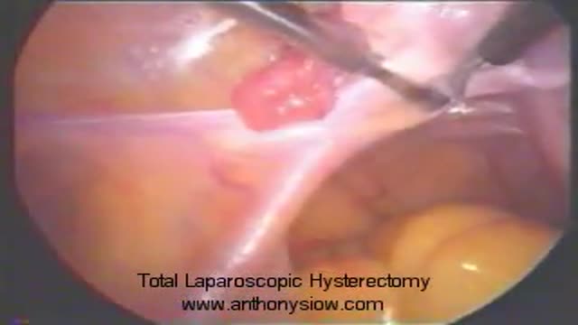 Total Laparoscopic Hysterectomy