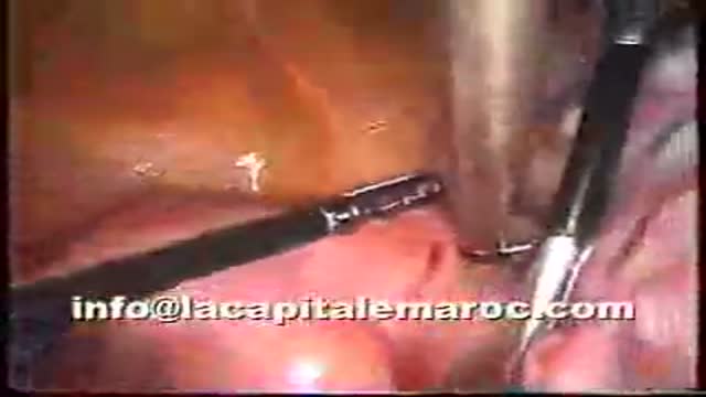 laparoscopic polymyomectomy