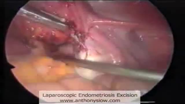 ⁣Endometriosis Excision