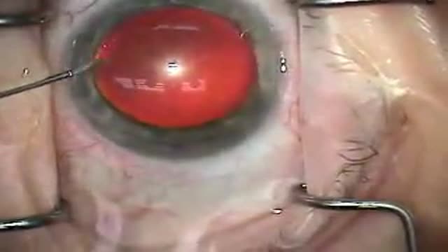 ⁣Modern Cataract Surgery