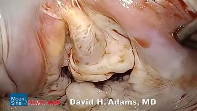 Mitral Valve Repair of Posterior Leaflet Prolapse HD