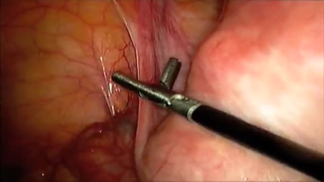 Laparoscopic Supracervical Hysterectomy