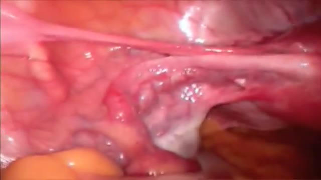 ⁣Total Hysterectomy Laparoscopic HD