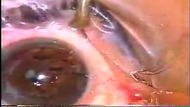 Corneal Graft