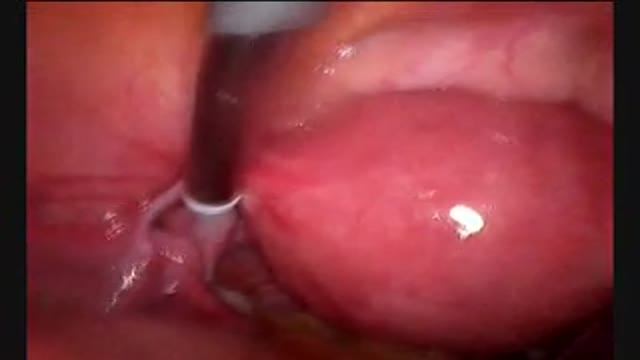 ⁣Tubal Ligation Surgery Video