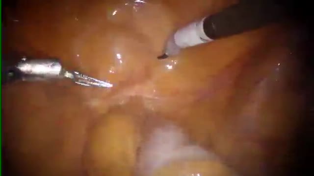 ⁣Robotic Prostatectomy Surgery HD