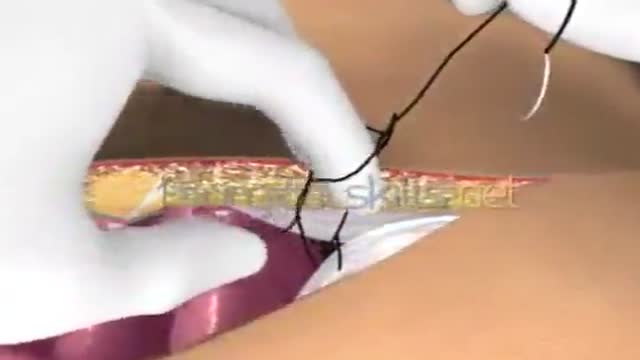 Laparotomy Closure Abdomen Animation