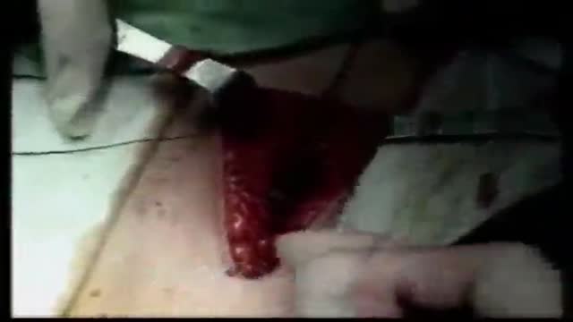 Abdominal Wall Closure