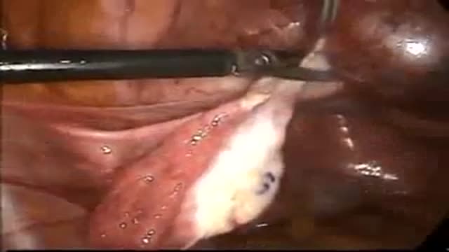 ⁣Ectopic Pregnancy in left Cornu Laparoscopic Surgery