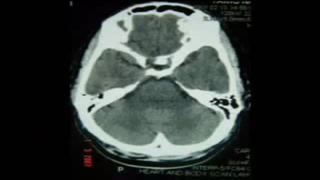⁣Right PCA Aneurysm Clipping Posterior Cerebral Artery