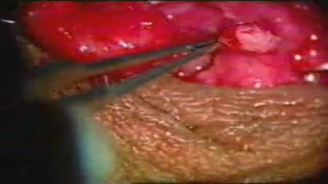⁣Vasovasostomy Vasectomy Reversal