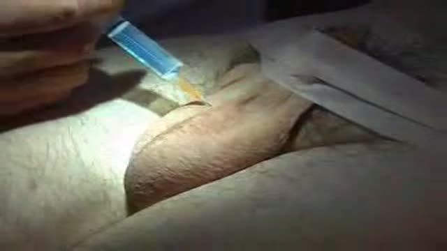 ⁣Vasectomy Procedure Video for Men