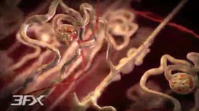 ⁣Diabetic Nephropathy Animation 3D