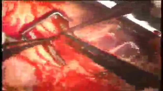 Arteriolotomy Open Heart Surgery