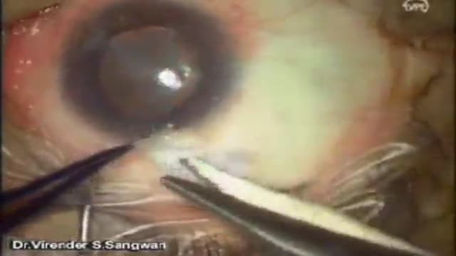 ⁣Keratectomy with Amniotic Membrane Graft Eye