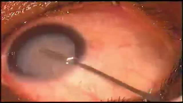 ⁣Eye Phacoemulsification