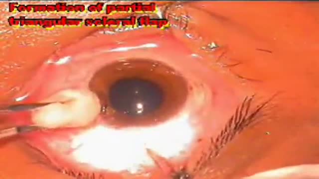 ⁣Eye Surgery Trabeculectomy