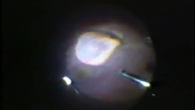 Eye Cyst Removal By Vitrectomy