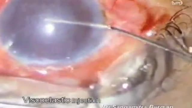 ⁣Eye Surgery penetrating Keratoplasty