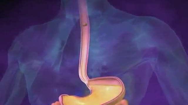 ⁣Urinary and Fecal Incontinence Animation