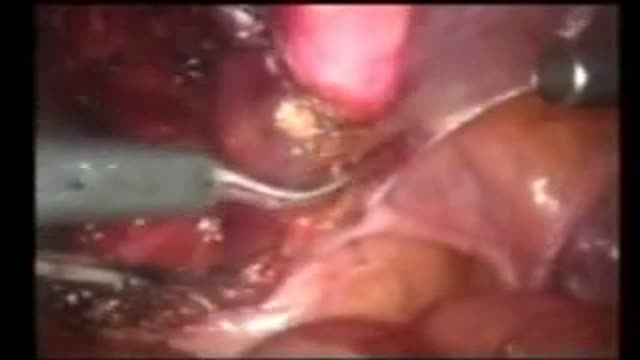 ⁣Sutureless laparoscopic radical Prostatectomy