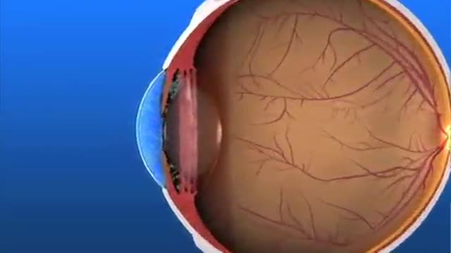 ⁣Glaucoma Pathogenesis Simplified