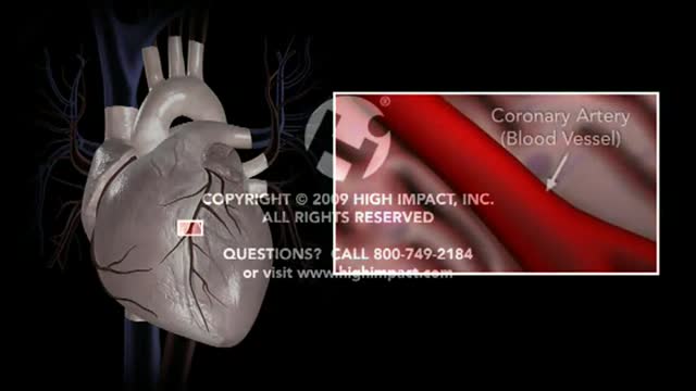 ⁣Coronary Artery Atherosclerosis