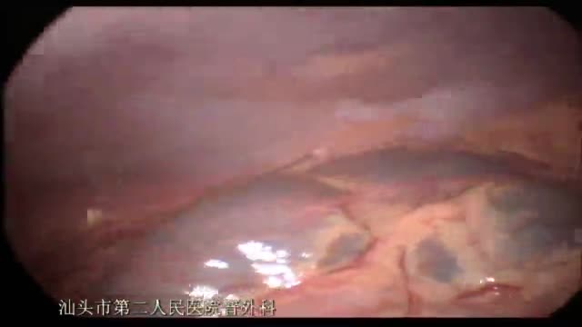 腹腔镜十二指肠球部溃疡修补术