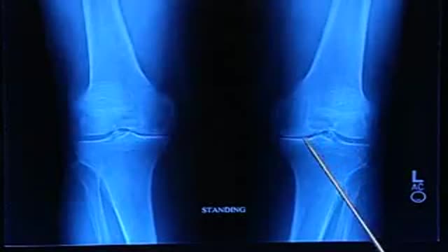 ⁣Total Knee Replacement